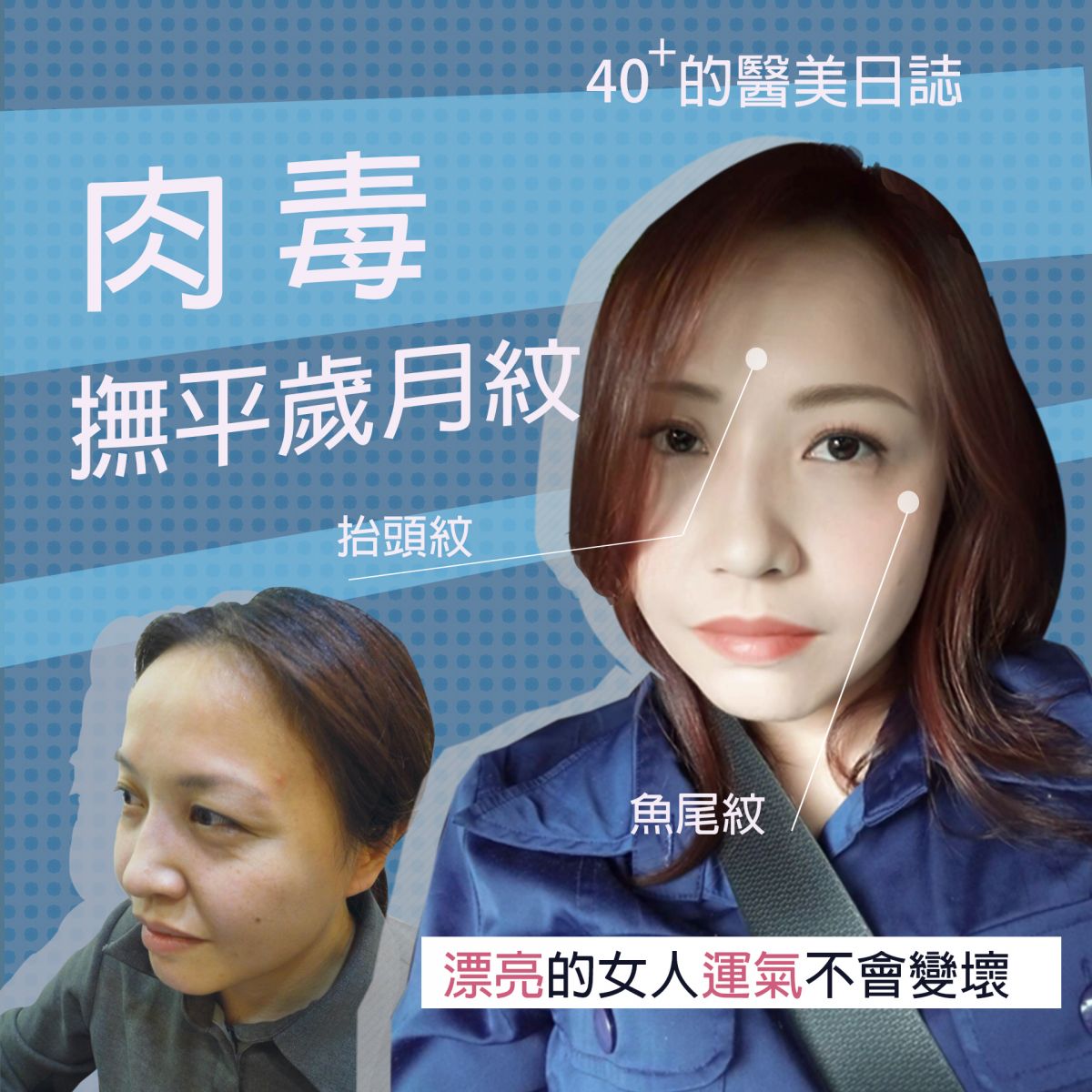 肉毒適應症 肌膚老化/緊緻修復/黑眼圈/皺紋/蟹足腫